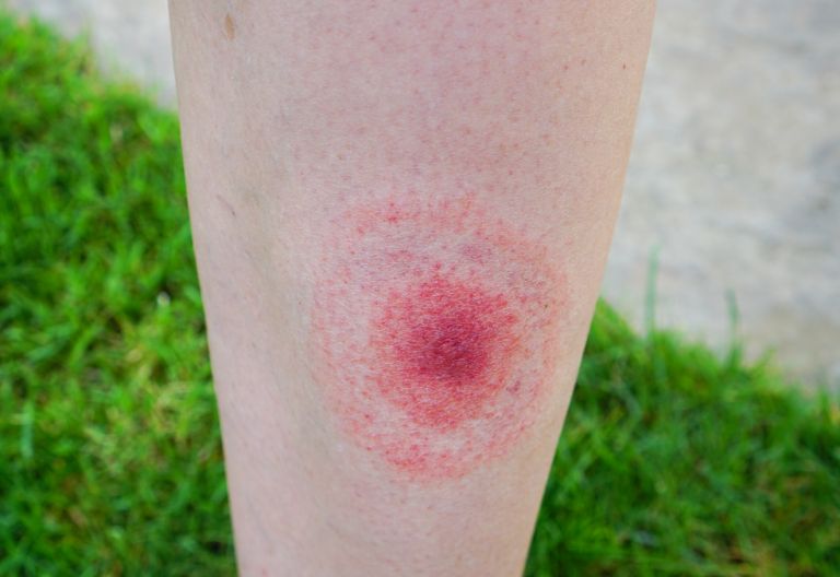 Najpogostejša klopna bolezen – cepiva ni, zato je previdnost nujna Najpogostejša klopna bolezen – cepiva ni, zato je previdnost nujna